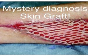 How Long Does it Take to Recover From a Skin Graft