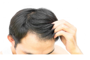 Best Instant Solution to Baldness in Australia