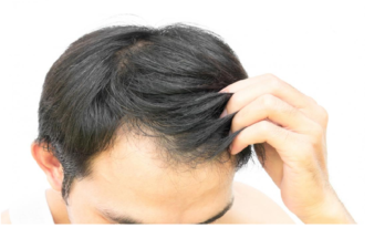Best Instant Solution to Baldness in Australia