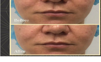 Treatments To Make You Look Younger