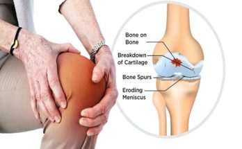 Helps Knee Osteoarthritis