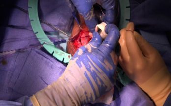 Repairing a Titan Implant's Broken Pump with Dr. Andrew Kramer