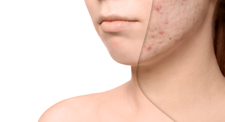 Treat Acne Scars