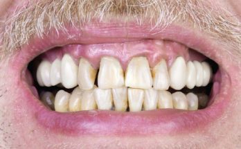 Cigarettes and Your Teeth
