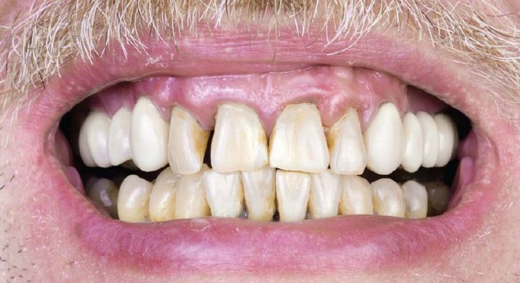Cigarettes and Your Teeth