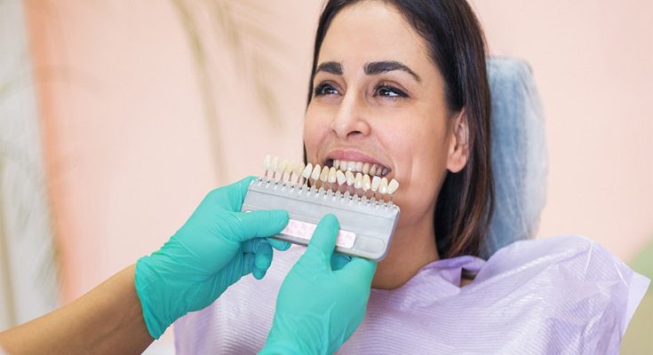 Everything You Need To Know About Dental Veneers!