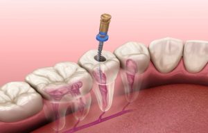 Successful Root Canal Treatment Can Keep You from Losing the Tooth