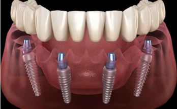 Detailed Information On Dental Implants Parramatta To