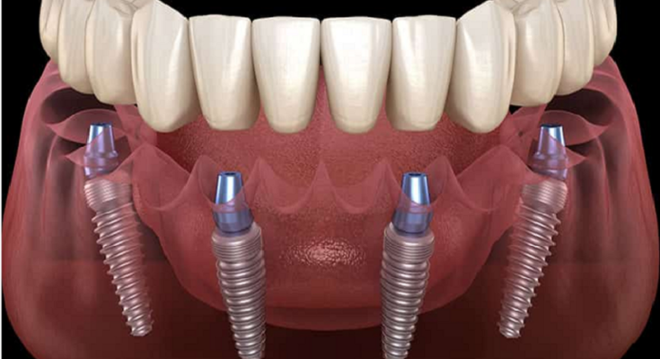 Detailed Information On Dental Implants Parramatta To