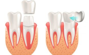 Dental Veneers vs. Dental Crowns