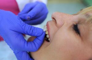 Veneers Cost