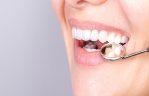 Dental Veneers