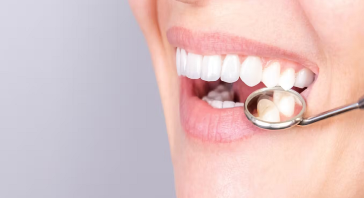 Dental Veneers